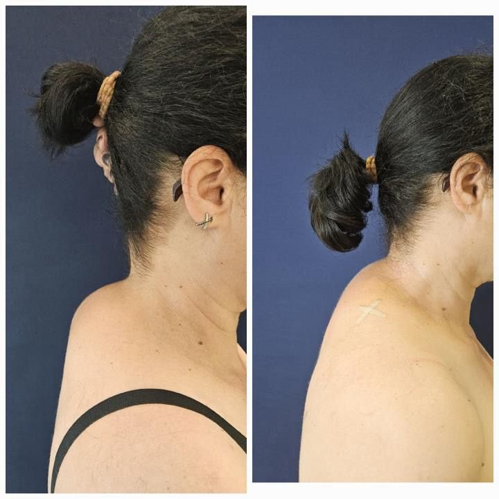 Lipoaspiratie "Cocoasa de bizon"