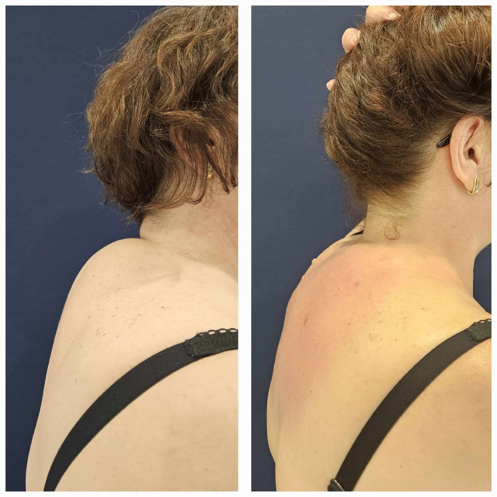 Lipoaspiratie "Cocoasa de bizon"