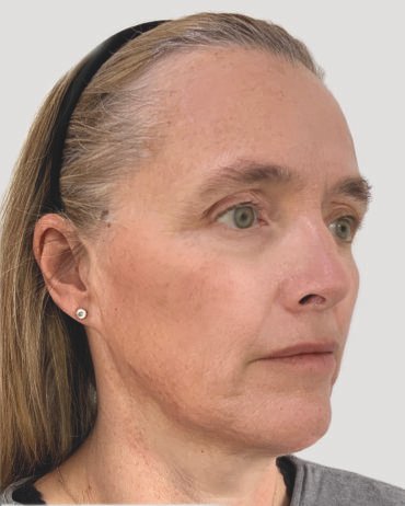 Profhilo Structura (after)