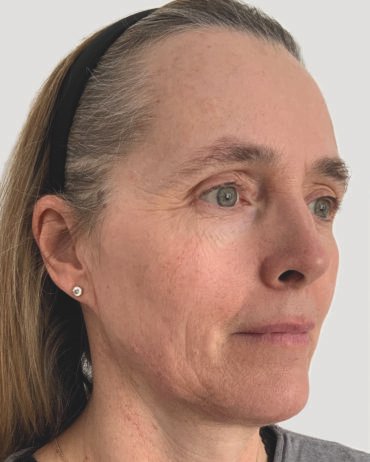 Profhilo Structura (before)