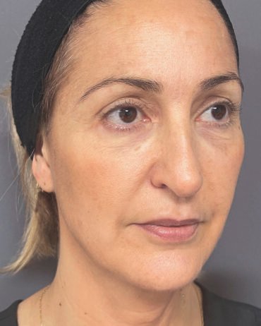 Profhilo Structura (after)