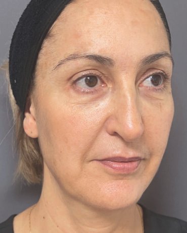 Profhilo Structura (before)