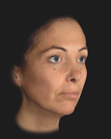 Profhilo Structura (after)