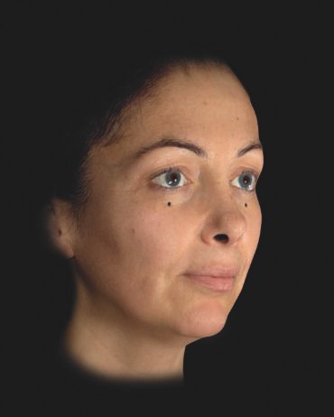 Profhilo Structura (before)