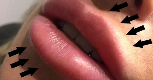 Migrarea acidului hialuronic din buze