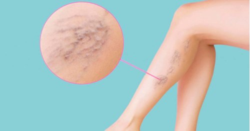 Varice - venele varicoase