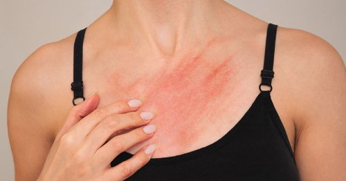 Tratamente pentru petele rosii