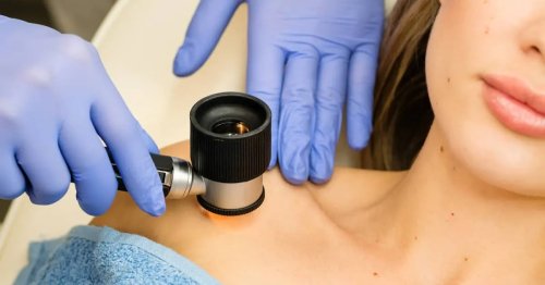 Verificare alunite (nev pigmentar)