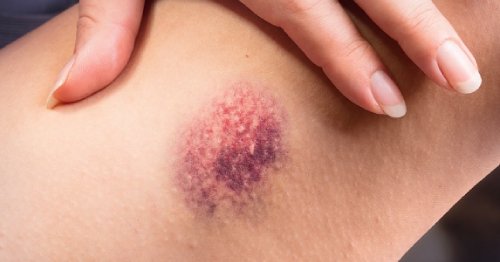 Totul despre vânătăi