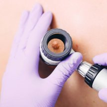 Procedura de dermatoscopie