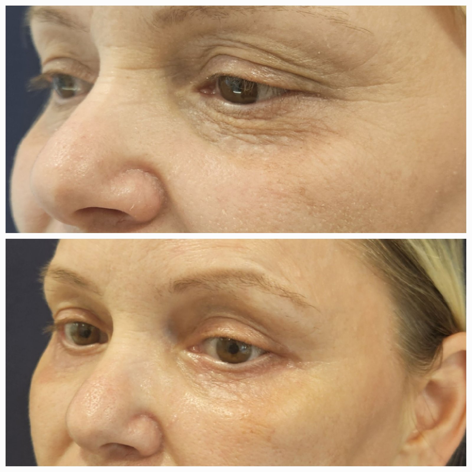 Blefaroplastie inferioara chirurgicala - Transcutanata (exemplu 1)