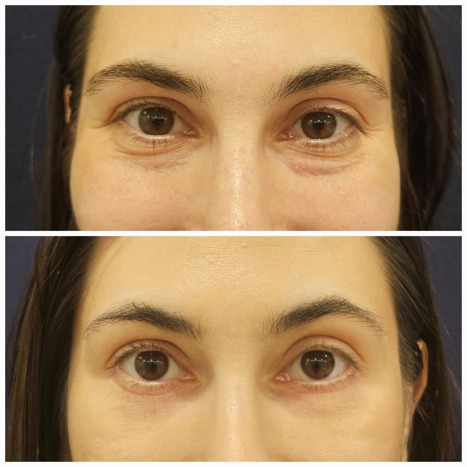 Blefaroplastie inferioara chirurgicala - Transcutanata (exemplu 10)