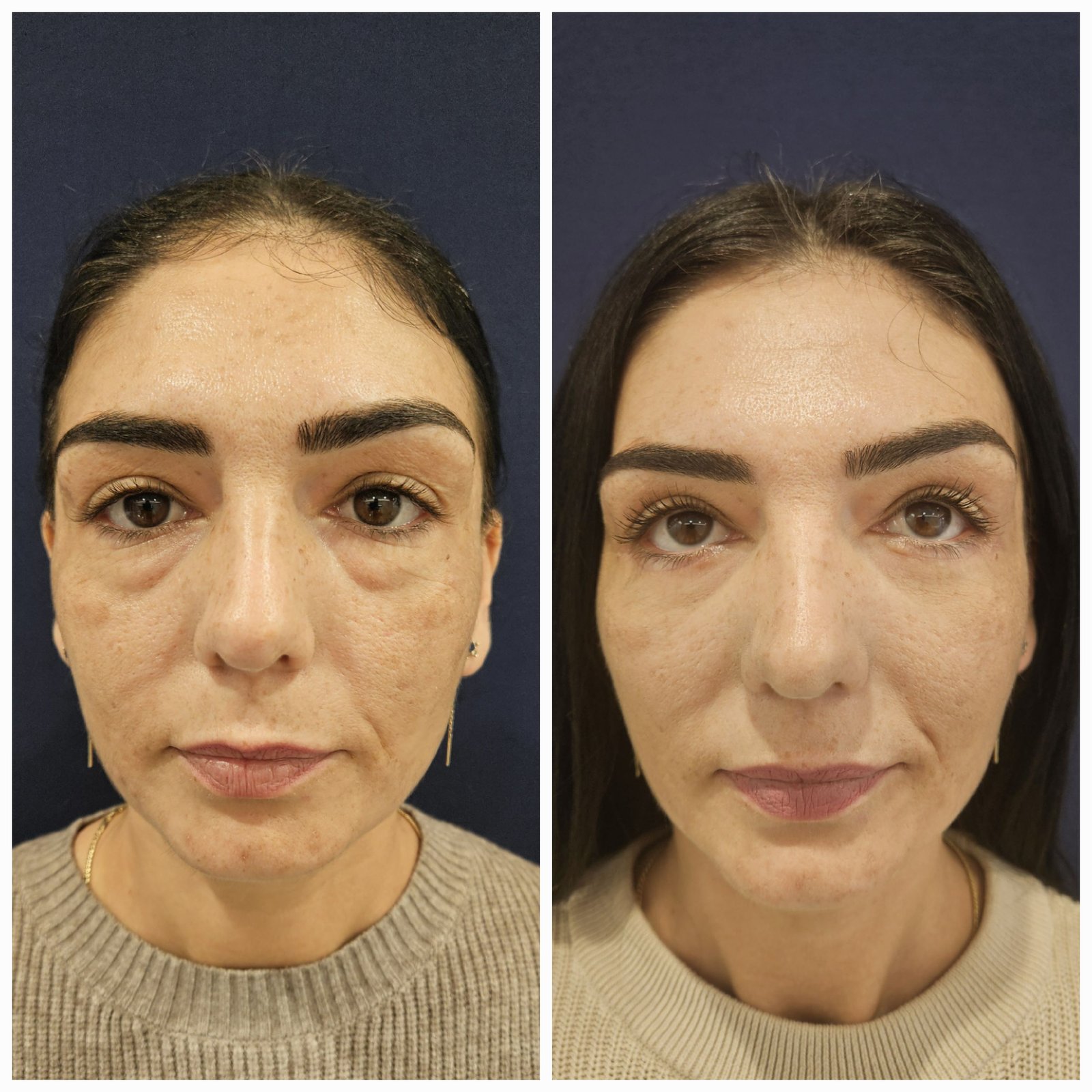 Blefaroplastie inferioara chirurgicala - Transcutanata (exemplu 11)