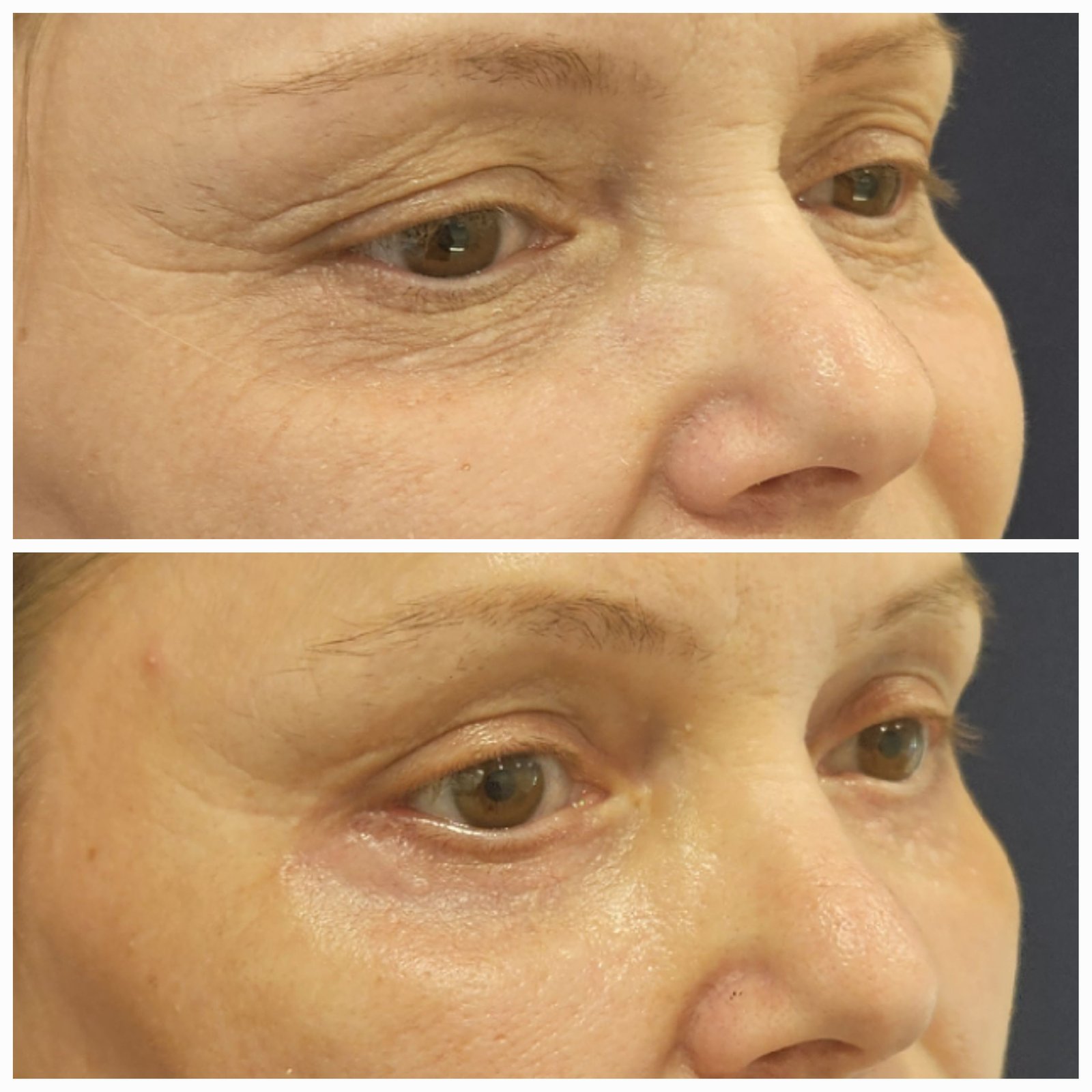 Blefaroplastie inferioara chirurgicala - Transcutanata (exemplu 2)