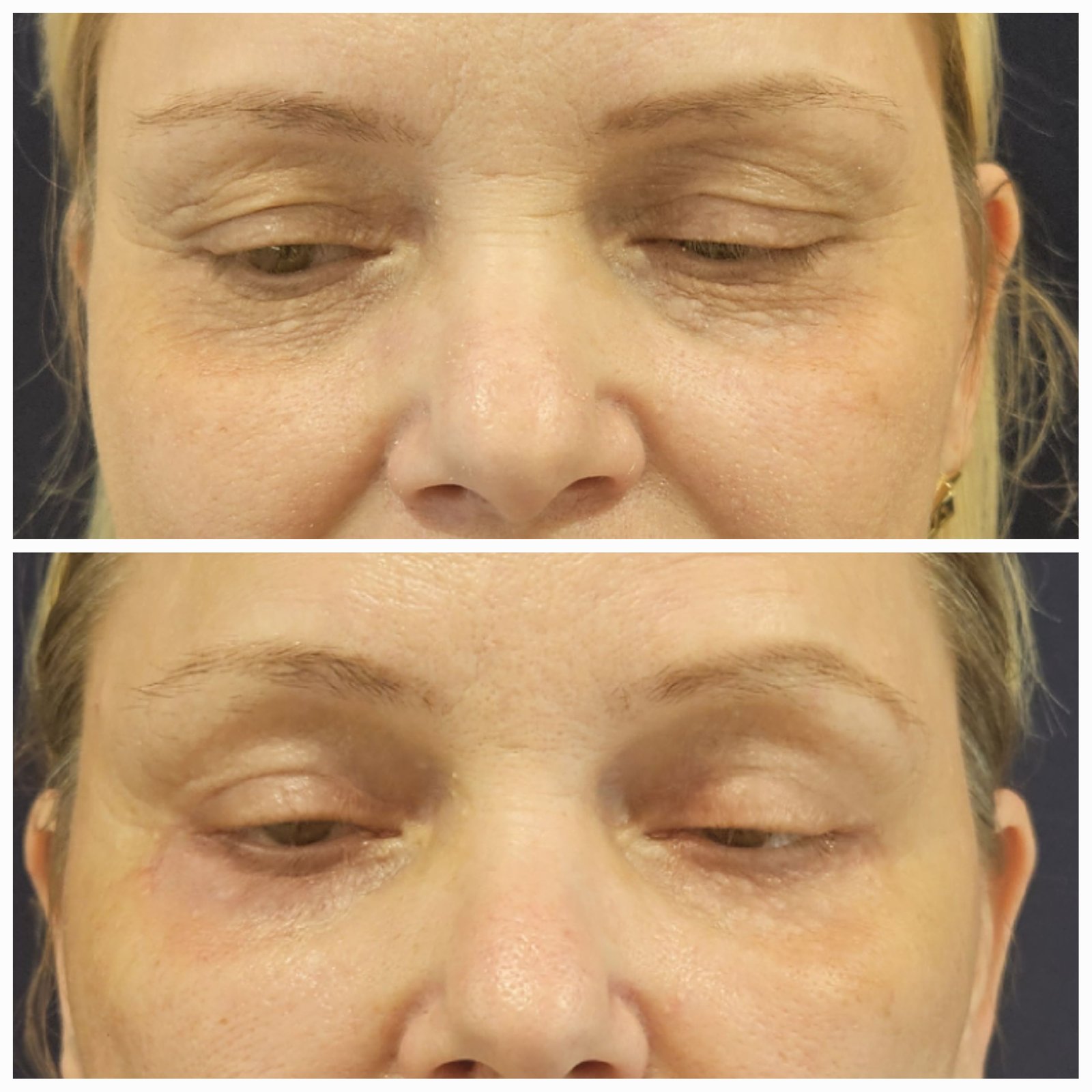 Blefaroplastie inferioara chirurgicala - Transcutanata (exemplu 3)