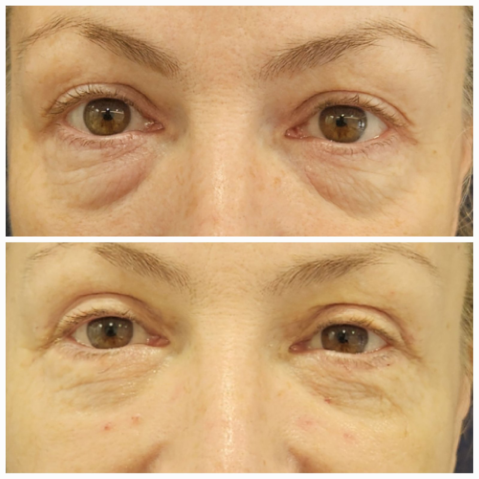 Blefaroplastie inferioara chirurgicala - Transcutanata (exemplu 4)