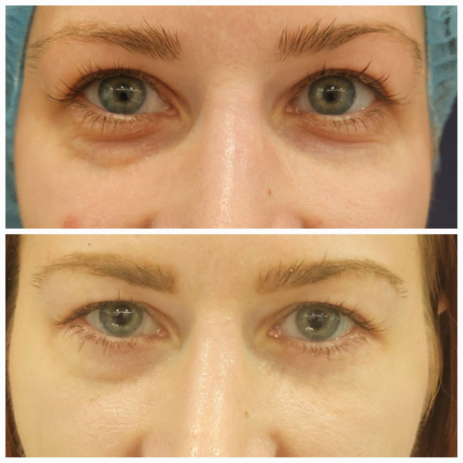 Blefaroplastie inferioara chirurgicala - Transcutanata (exemplu 5)