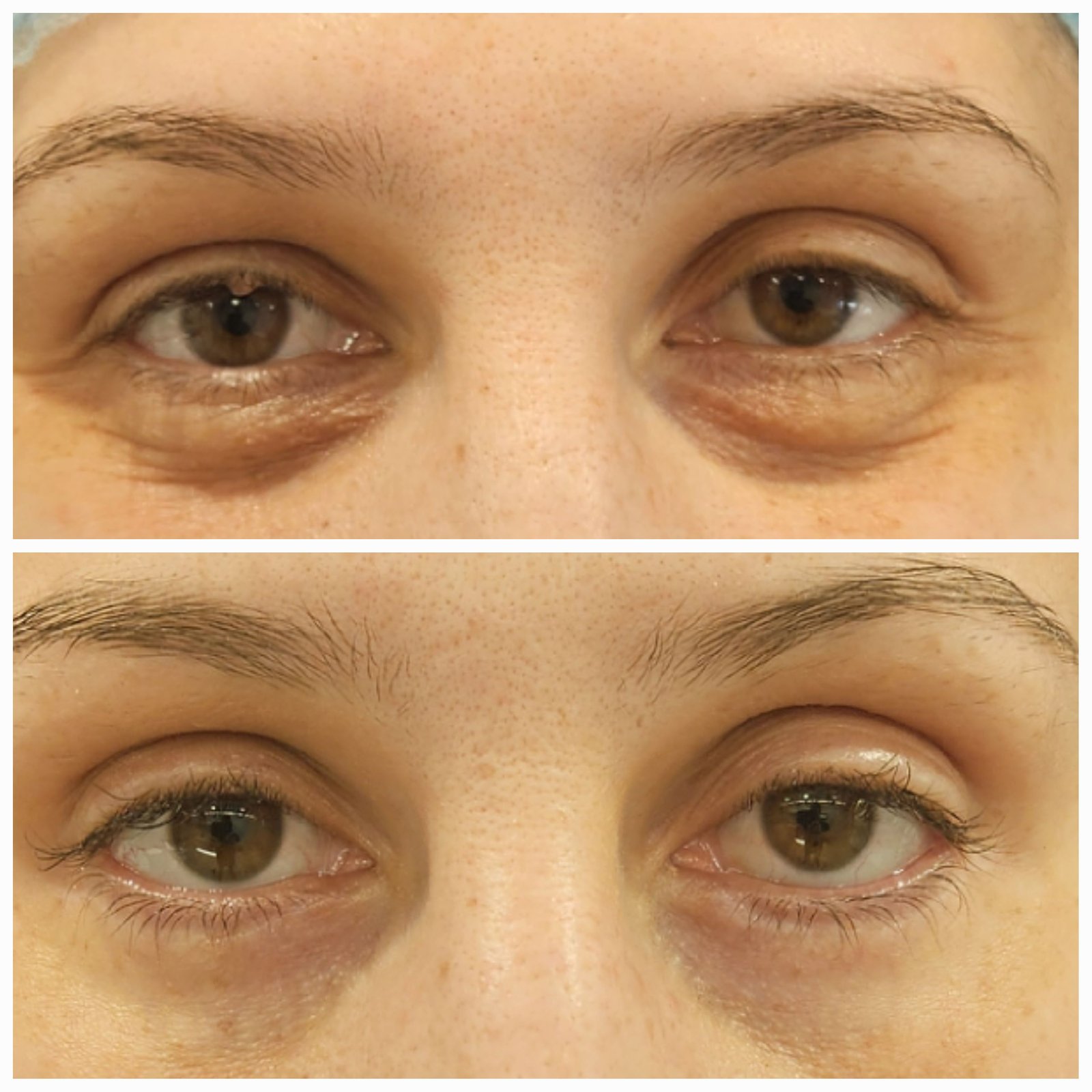 Blefaroplastie inferioara chirurgicala - Transcutanata (exemplu 6)