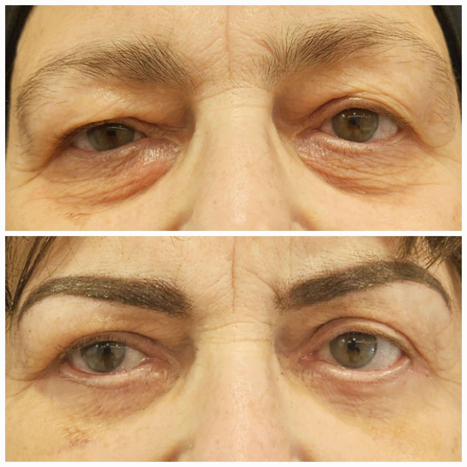 Blefaroplastie inferioara chirurgicala - Transcutanata (exemplu 7)