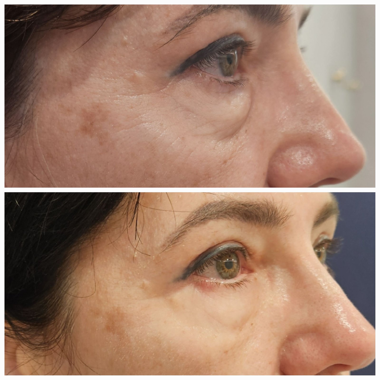 Blefaroplastie inferioara chirurgicala - Transcutanata (exemplu 8)