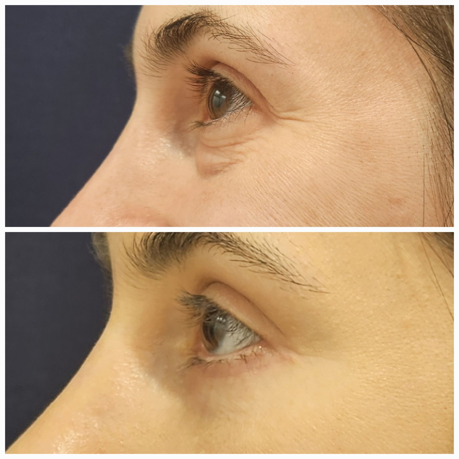 Blefaroplastie inferioara chirurgicala - Transcutanata (exemplu 9)