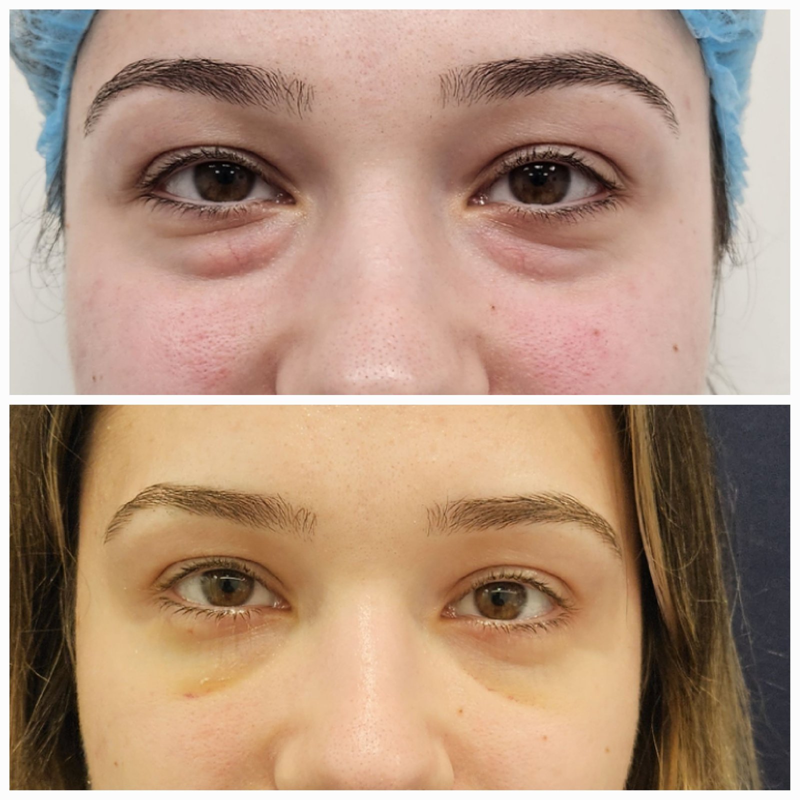 Blefaroplastie inferioara chirurgicala - Transconjuctivala (exemplu 1)