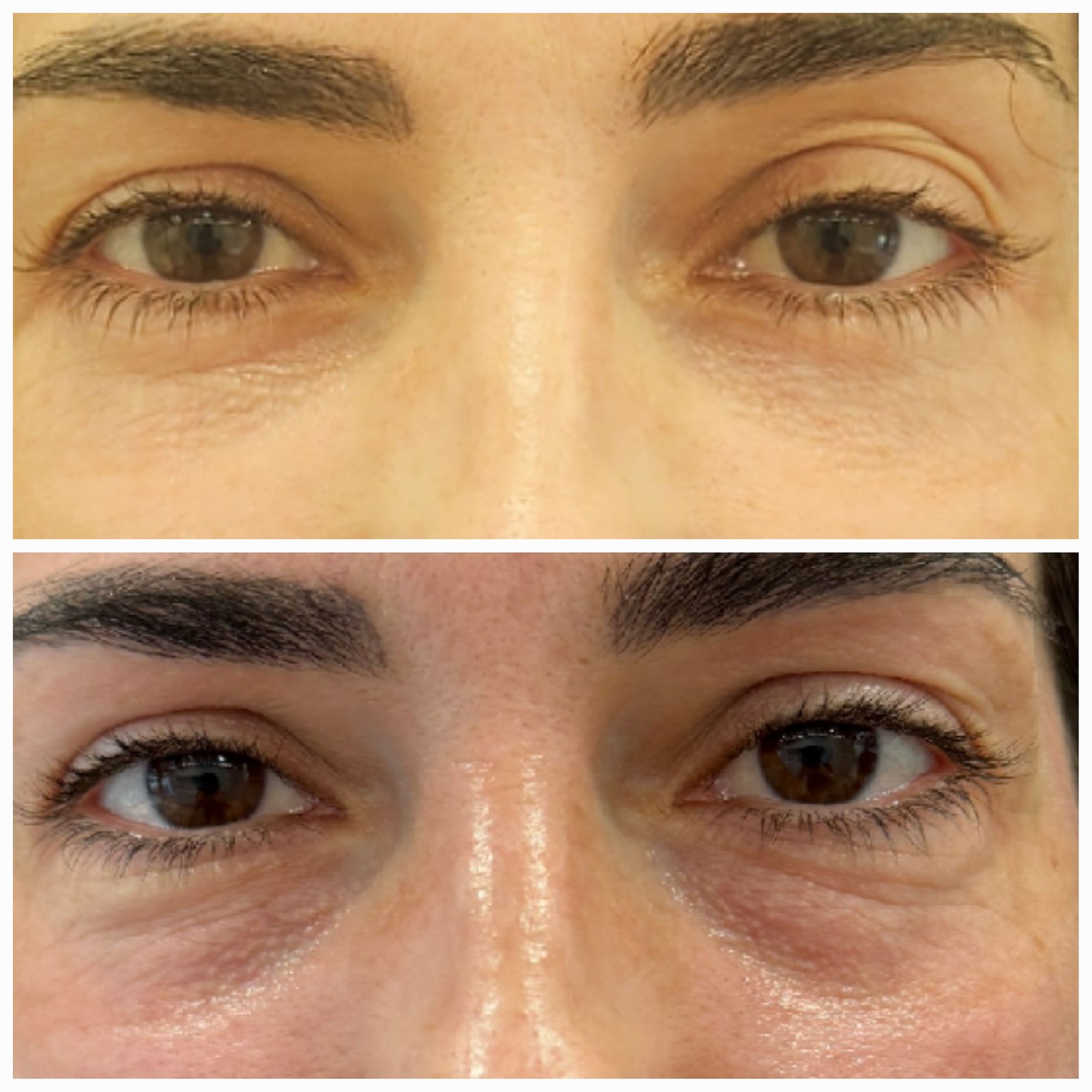 Blefaroplastie inferioara chirurgicala - Transconjuctivala (exemplu 2)