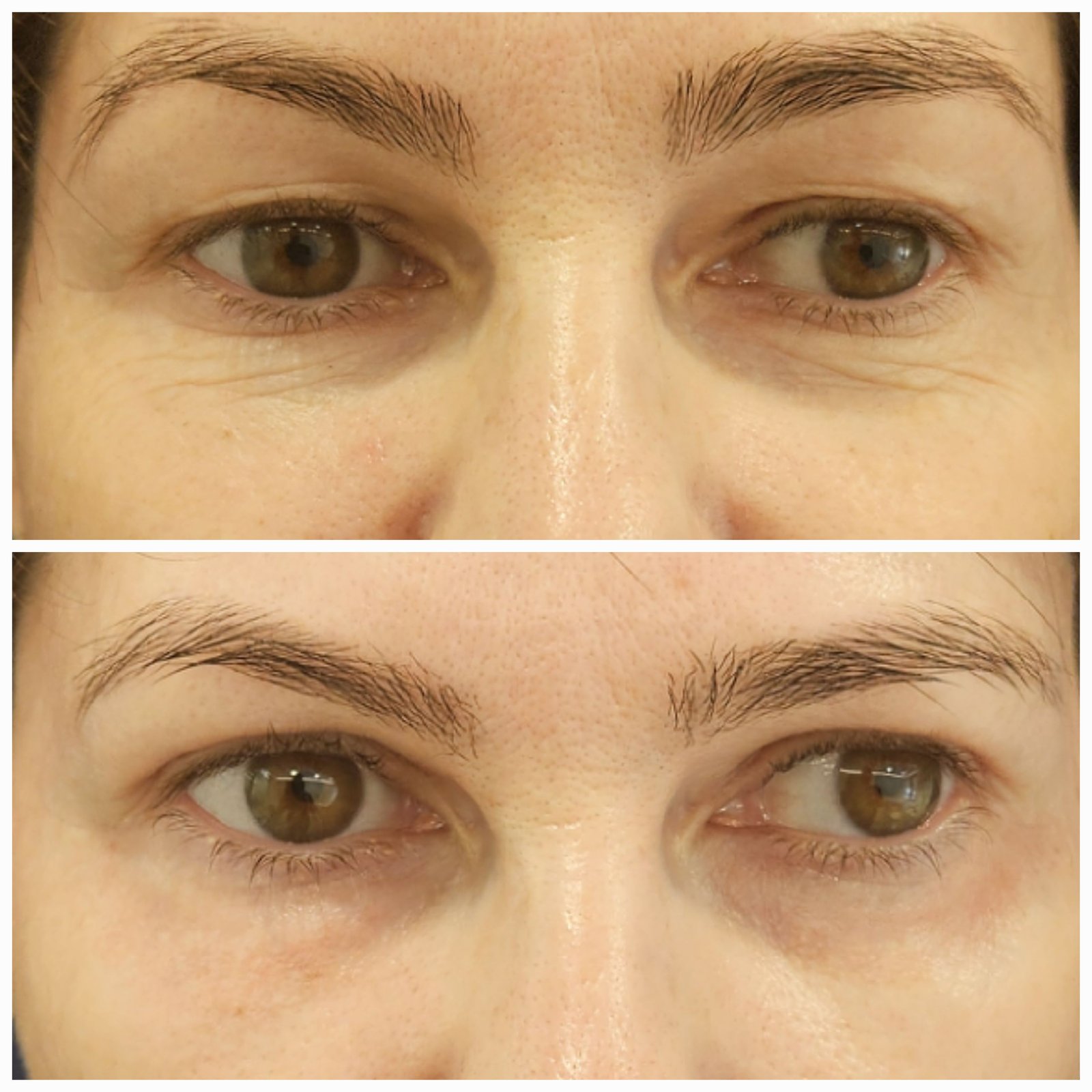 Blefaroplastie inferioara chirurgicala - Transconjuctivala (exemplu 3)