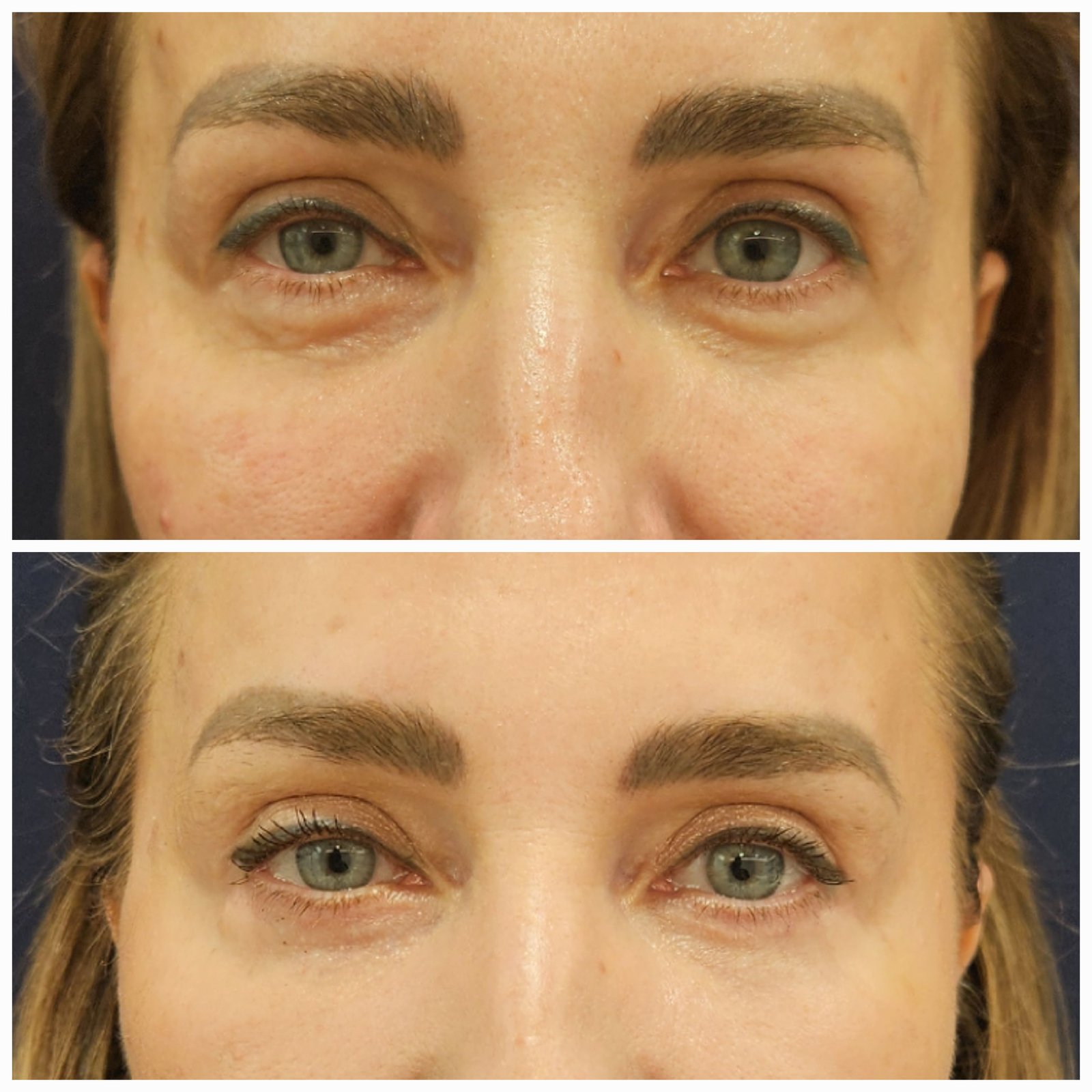 Blefaroplastie inferioara chirurgicala - Transconjuctivala (exemplu 4)
