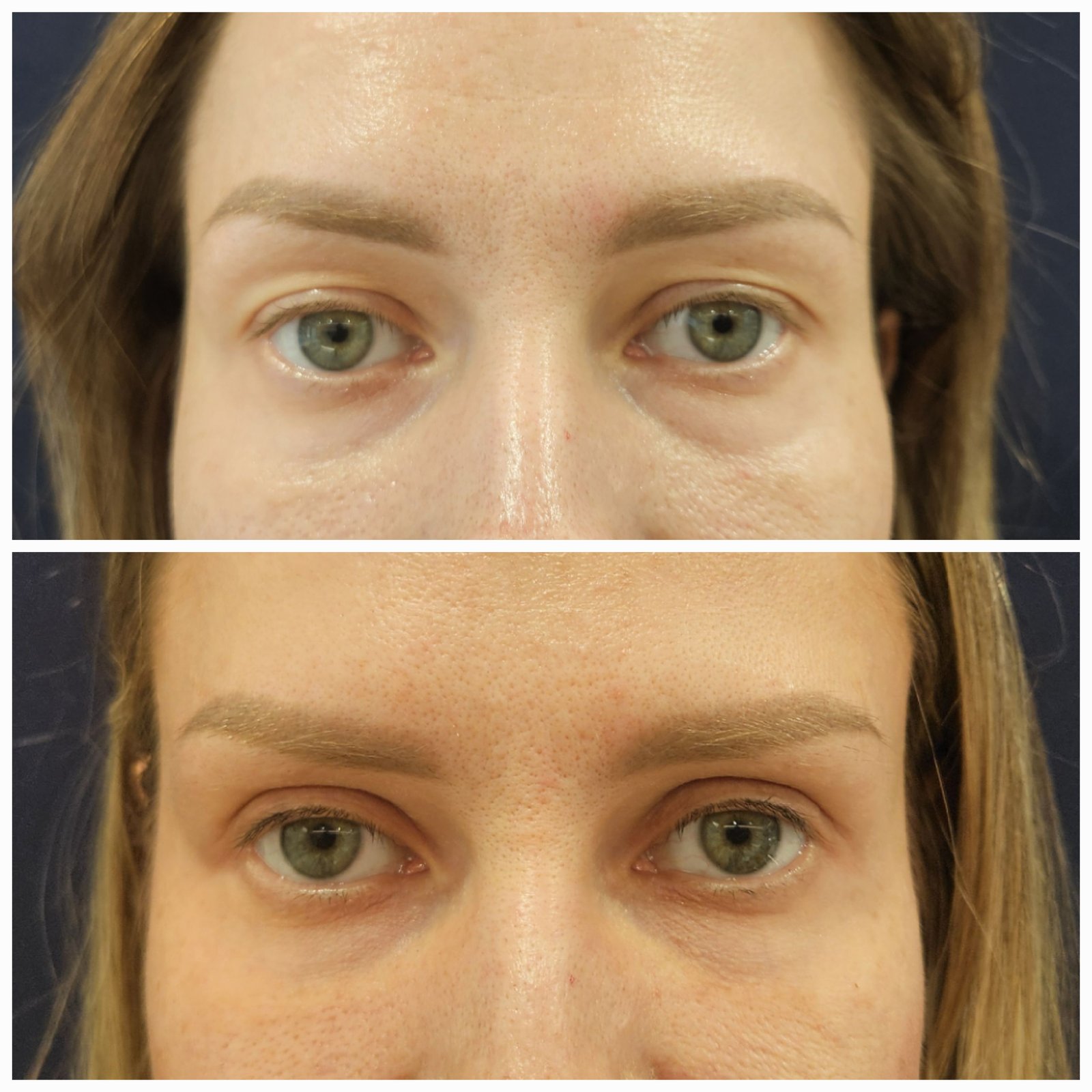 Blefaroplastie inferioara chirurgicala - Transconjuctivala (exemplu 5)
