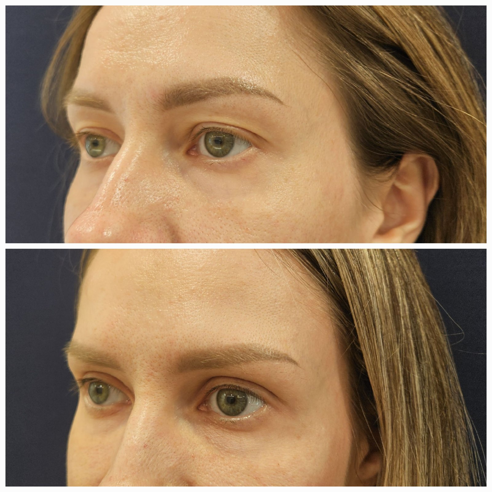 Blefaroplastie inferioara chirurgicala - Transconjuctivala (exemplu 6)