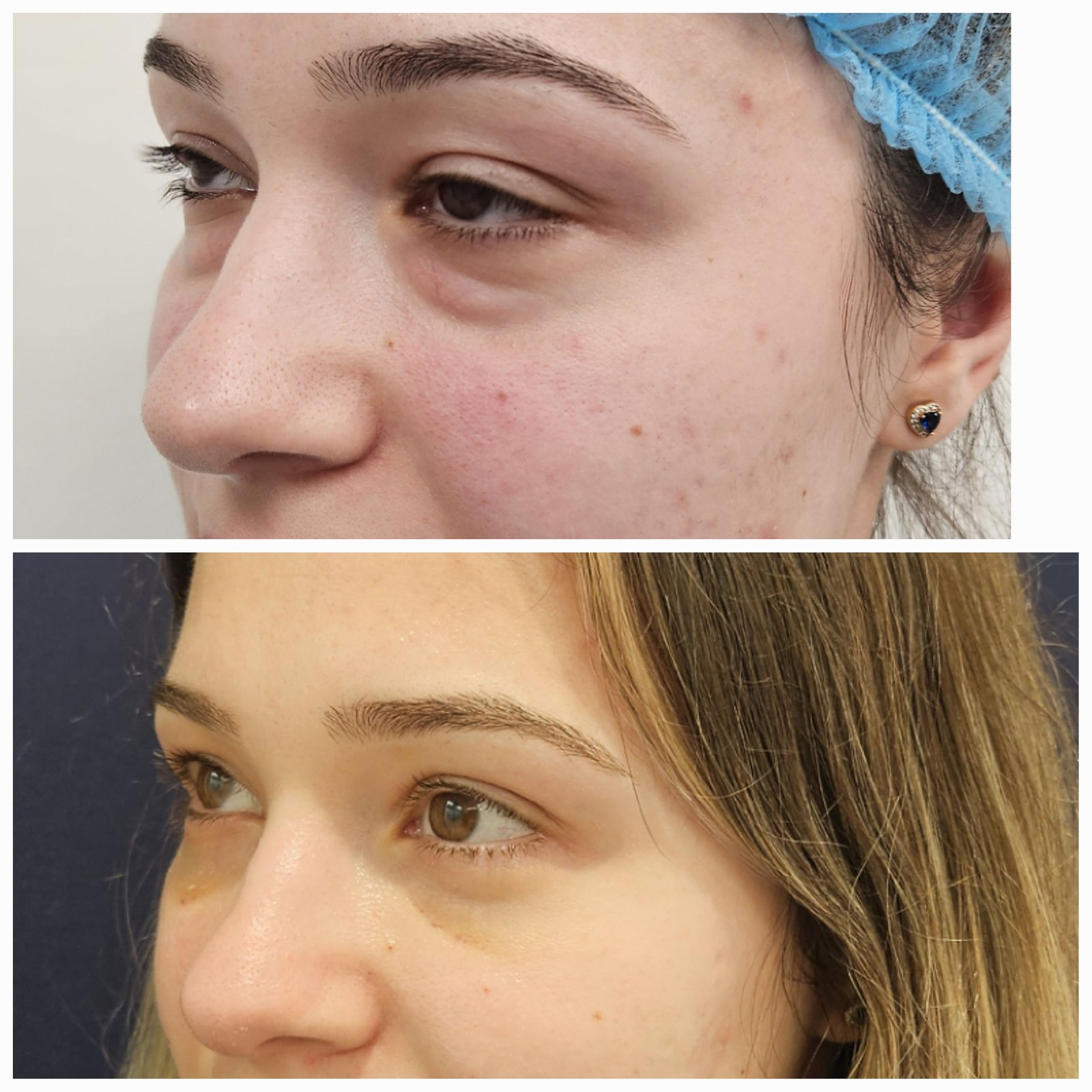 Blefaroplastie inferioara chirurgicala - Transconjuctivala (exemplu 7)